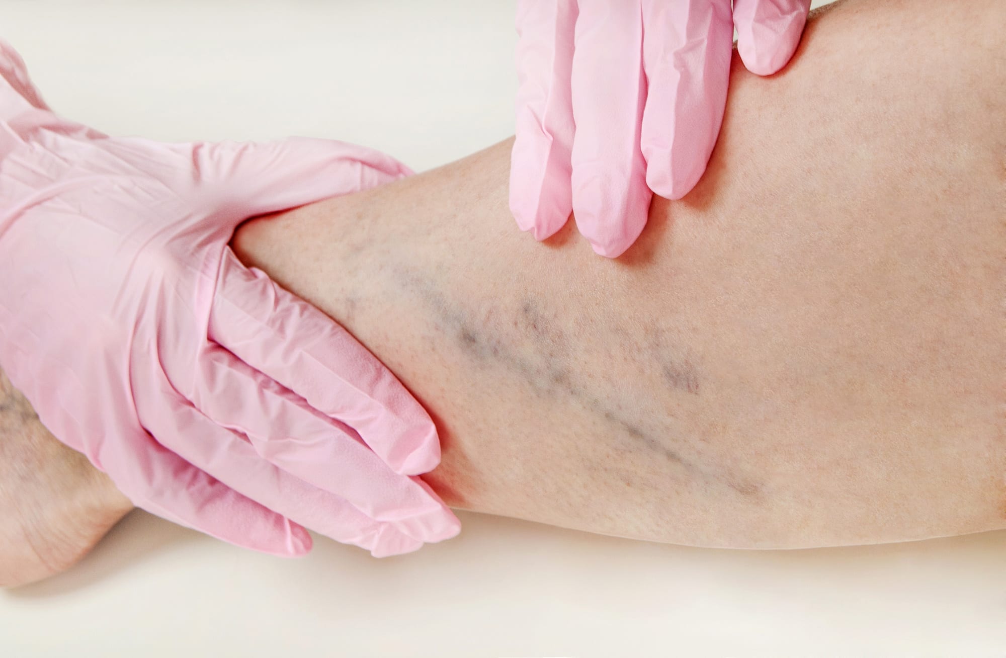 Varicose Vein Removal: 4 of the Best Treatments to Consider