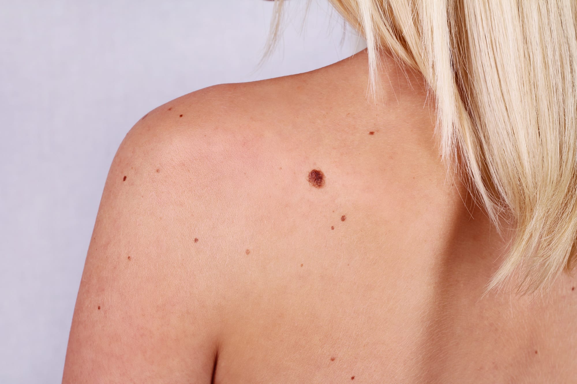 Young woman with at birthmark on her back, skin. Checking benign moles