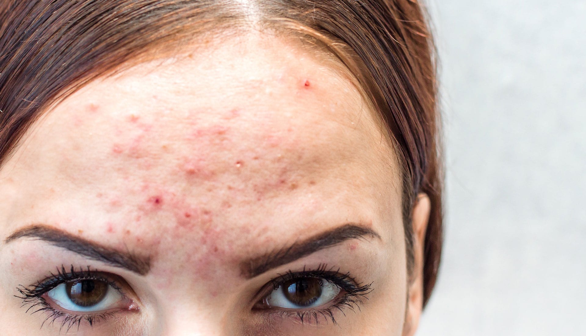 Acne Treatment | Solutions For Even The Worst Acne Cases