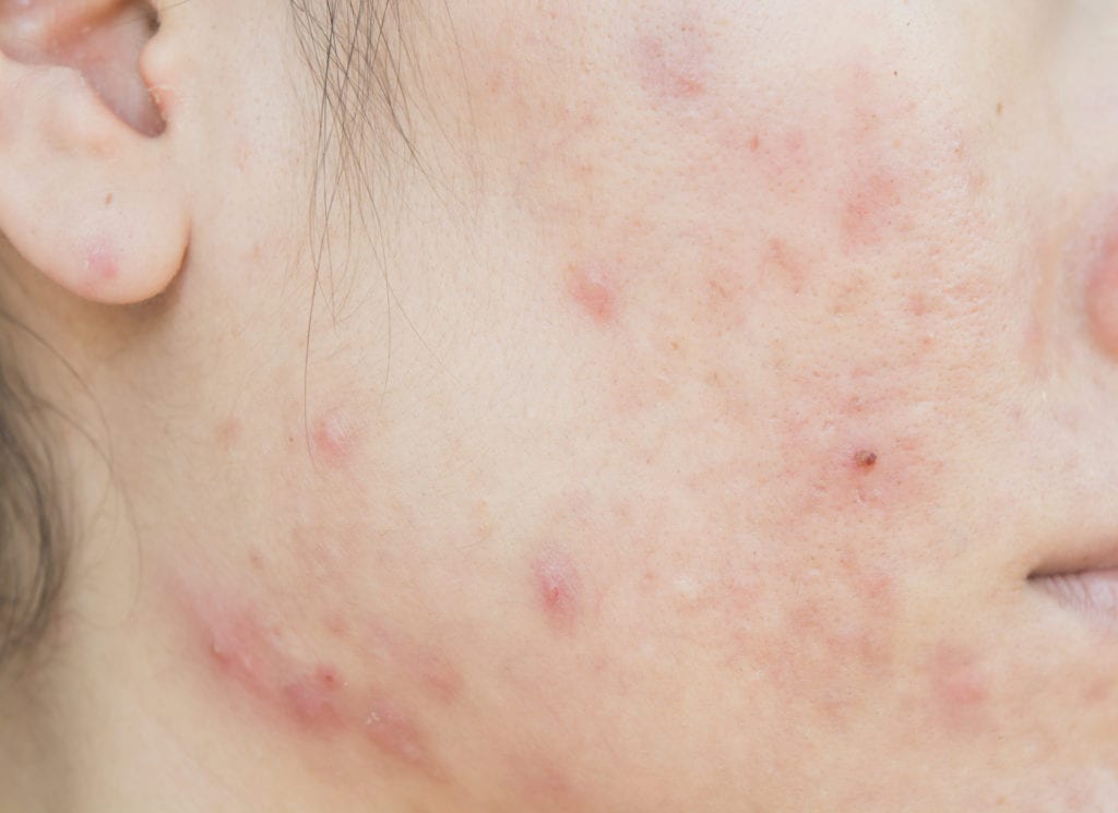 What is Epuris acne treatment?