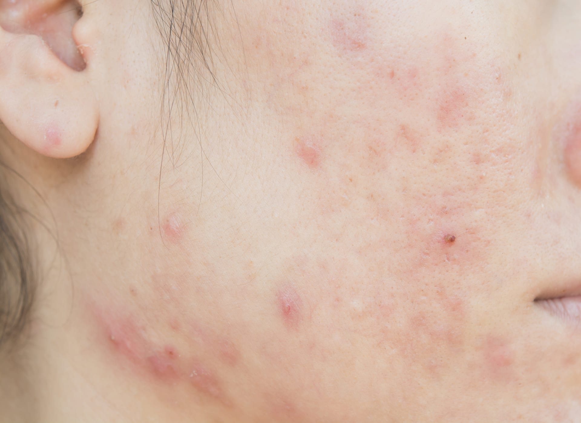 What is Epuris acne treatment?