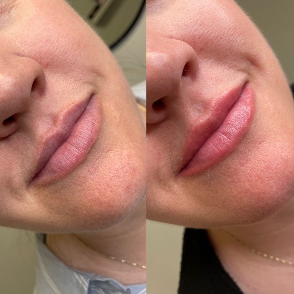 woman getting lip brushing treatment